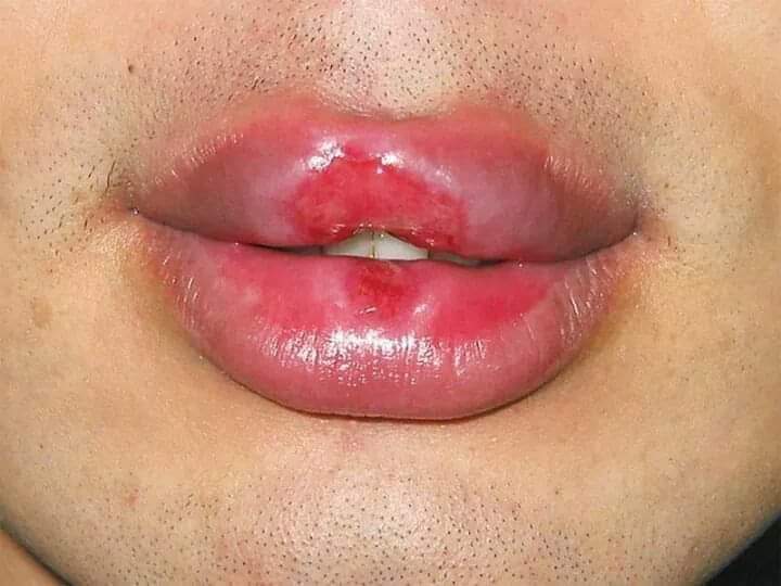 how to get rid of lip pimples quick