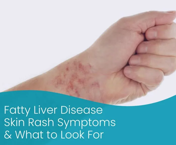 fatty-liver-liver-disease-skin-rash-pictures-full-information-2023