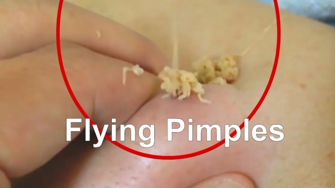 flying exploding pimples