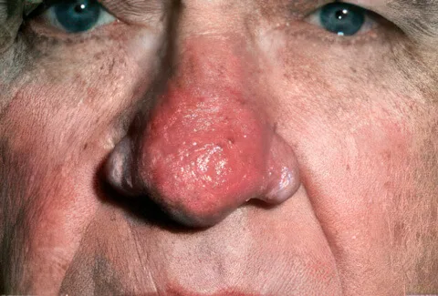 redness around the nose