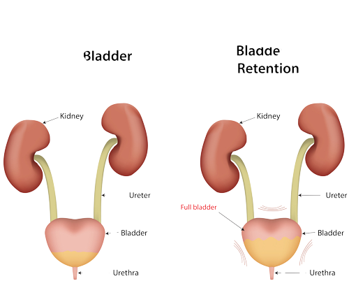 4-stages-of-passing-a-kidney-stone-amazing-health-tips-stoodmens