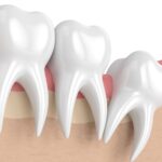 wisdom teeth removal side effects