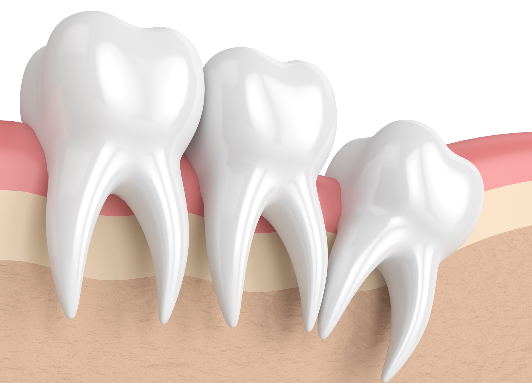 wisdom teeth removal side effects